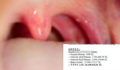 Bademcik ameliyatı sonrası engelli kaldı! 39 milyon liralık rekor tazminat talebi